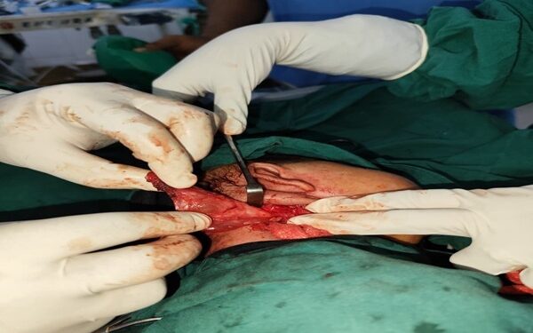 Rare Branchial Cyst Surgery on 43-Day-Old Baby in Amarpur