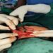 Rare Branchial Cyst Surgery on 43-Day-Old Baby in Amarpur